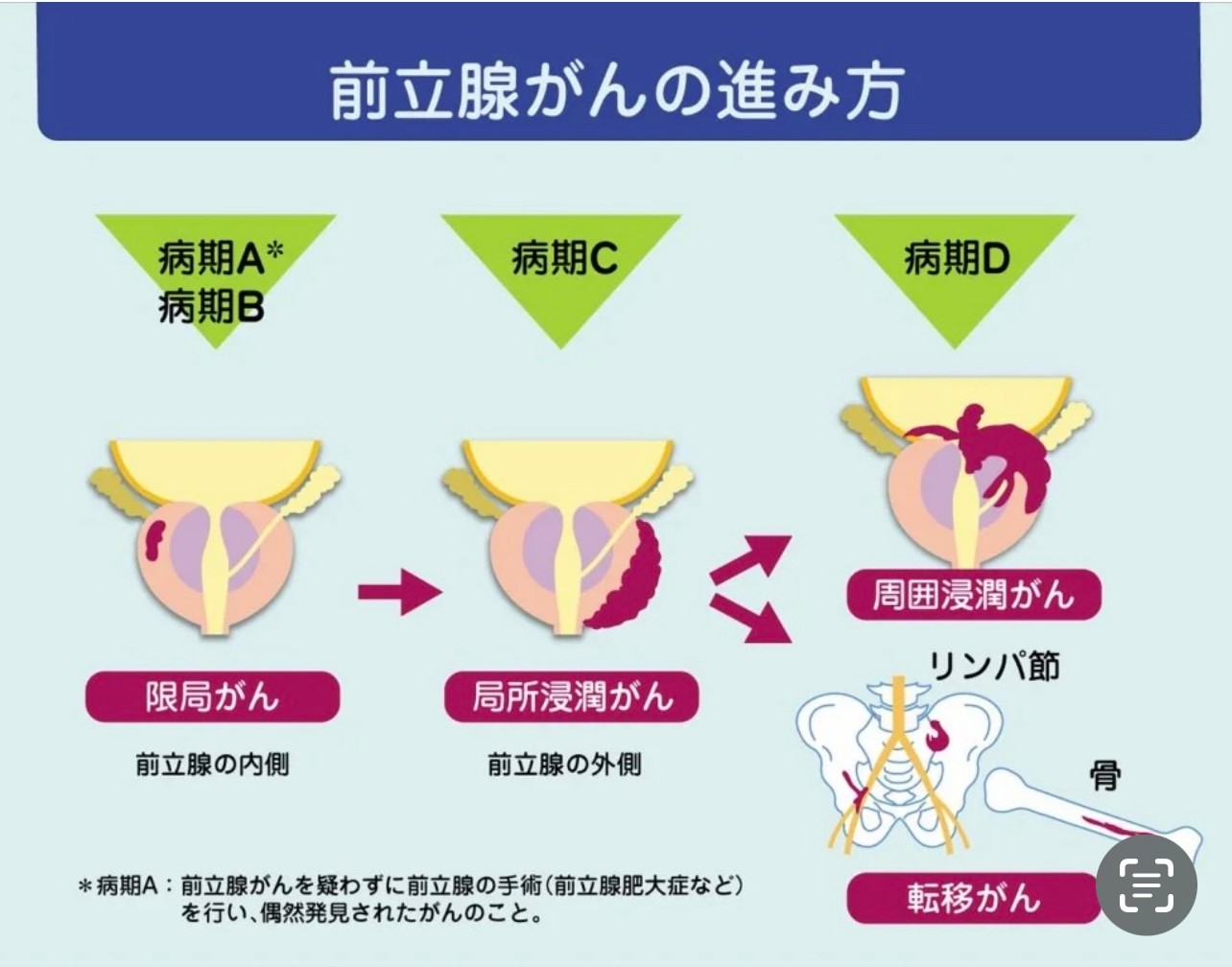 前立腺がん治療でよくある副作用